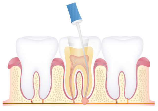 手用器具を使って歯髄を除去する。